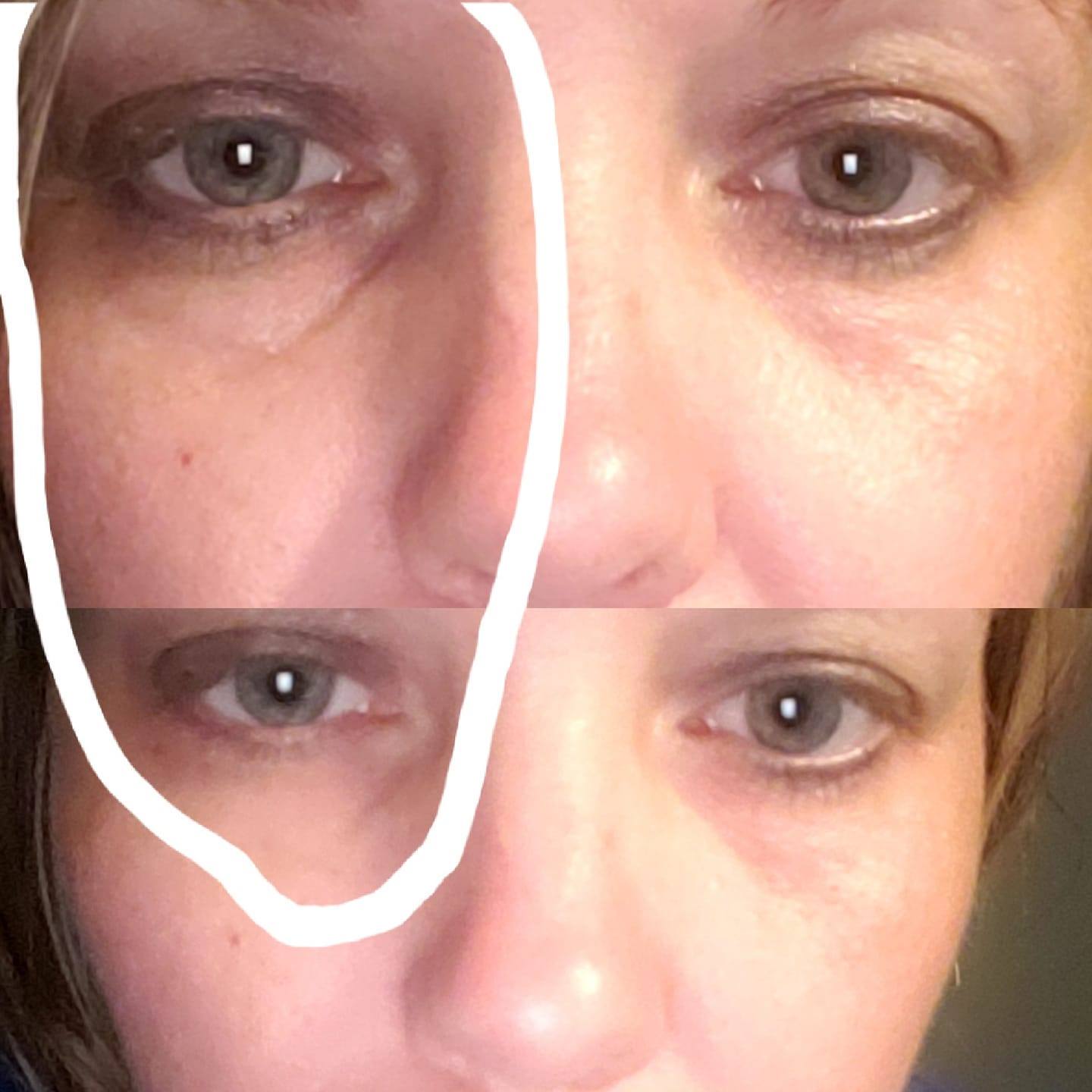 Rapid Rewind Undereye bags be gone