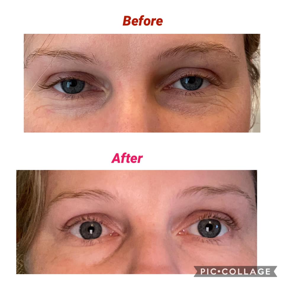 Rapid Rewind Undereye bags be gone