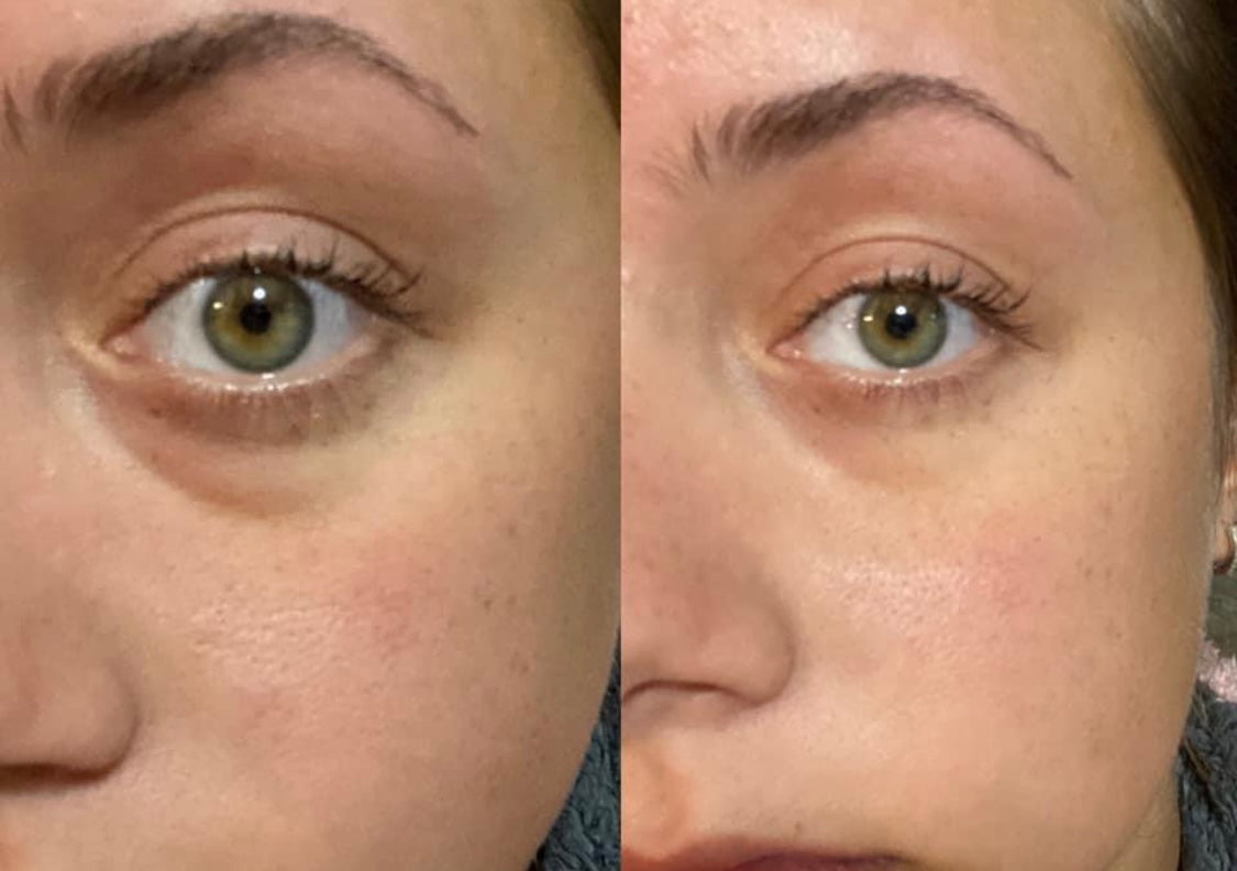 Rapid Rewind Undereye bags be gone